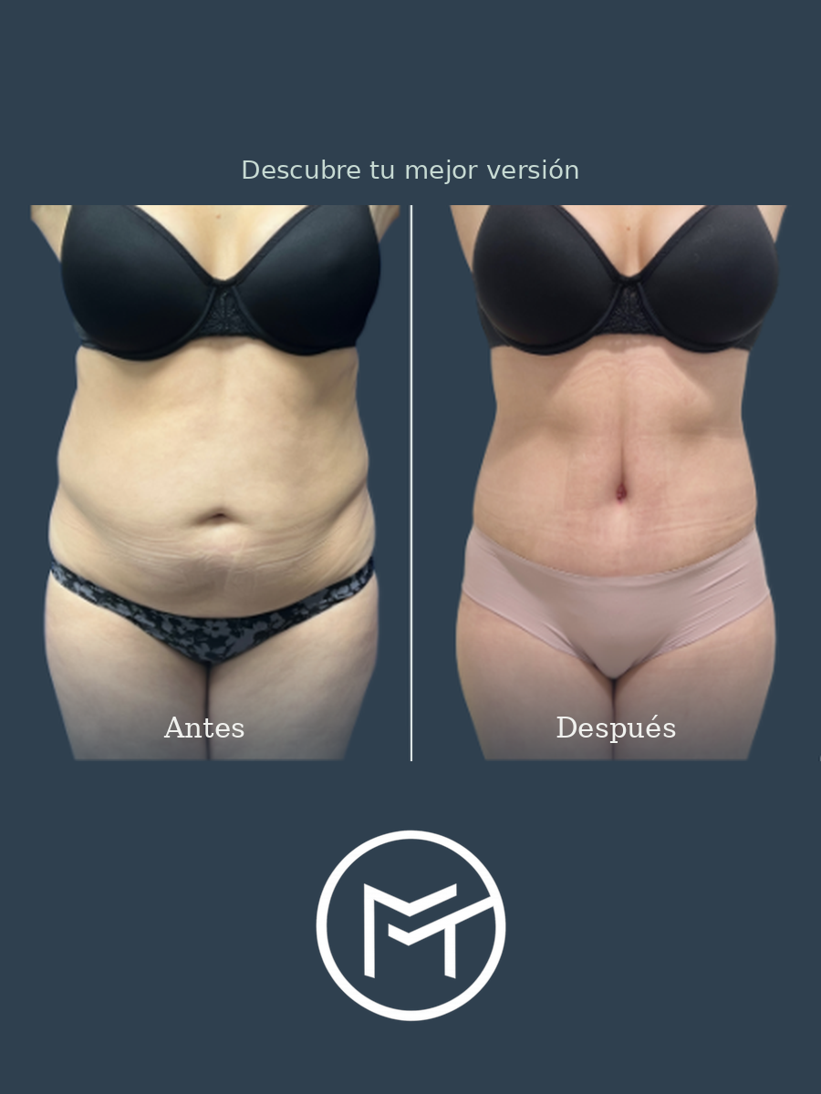 Resultado de abdominoplastia, vista frontal