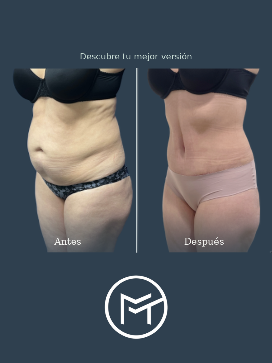 Resultado de abdominoplastia, vista oblicua