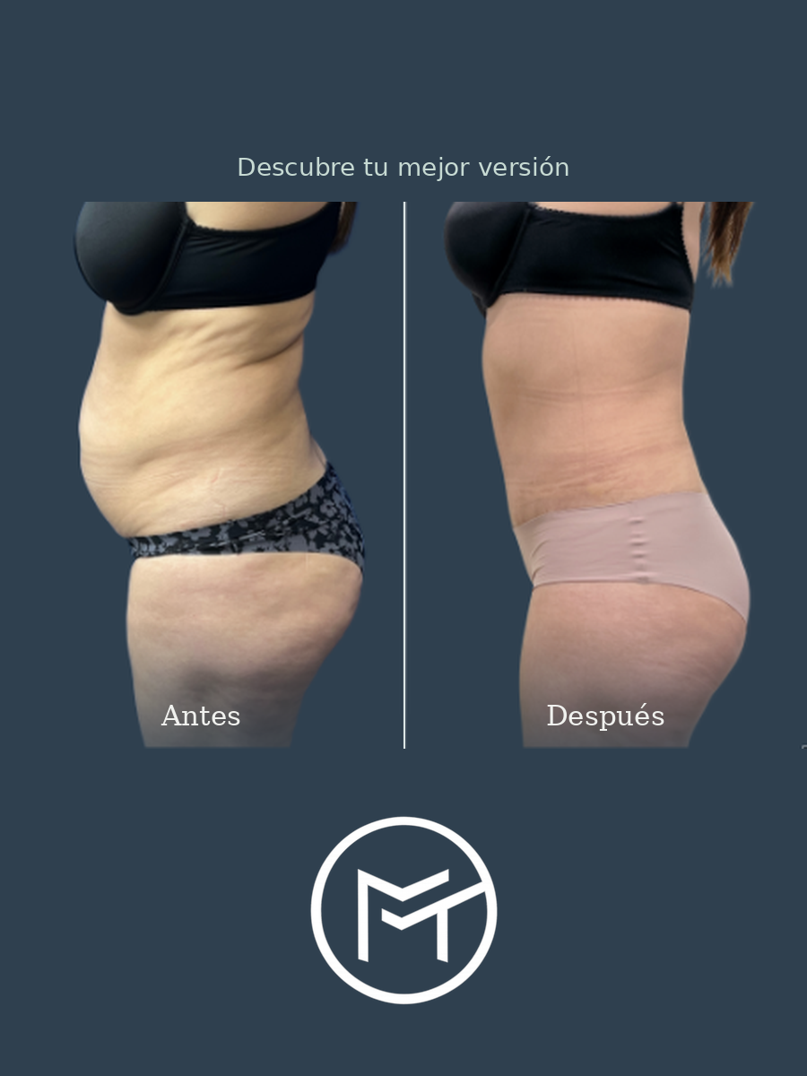 Resultado de abdominoplastia, vista lateral