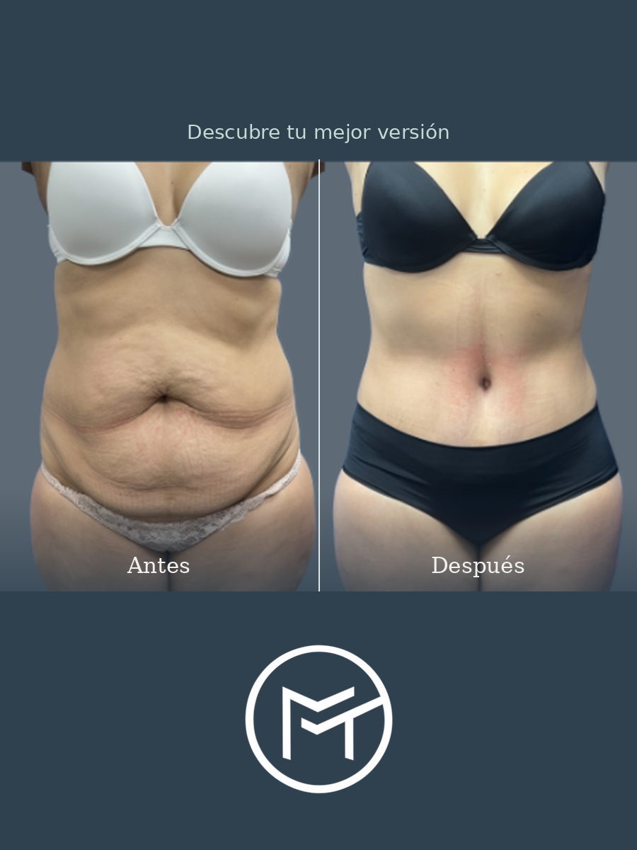 Resultado de lipoabdominoplastia, vista frontal