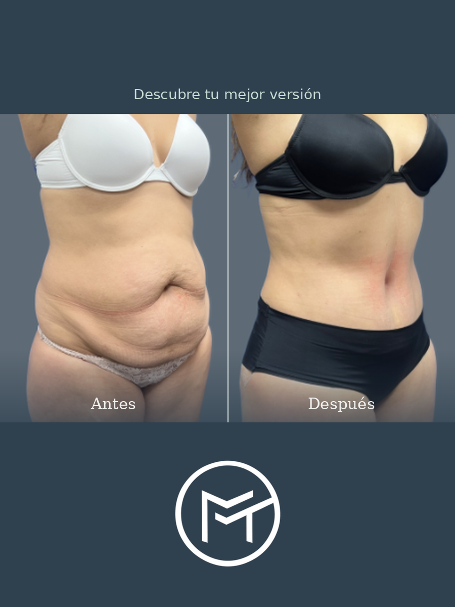 Resultado de lipoabdominoplastia, vista oblicua