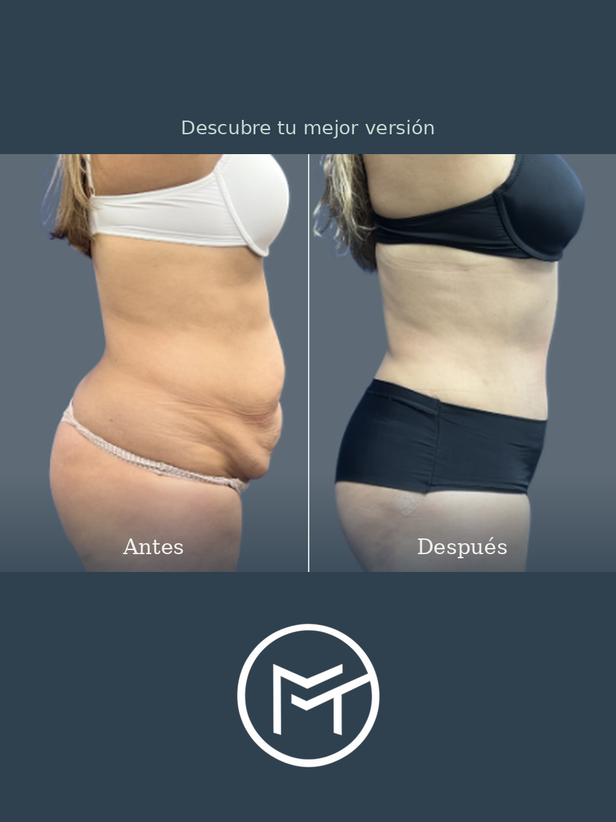 Resultado de lipoabdominoplastia, vista lateral